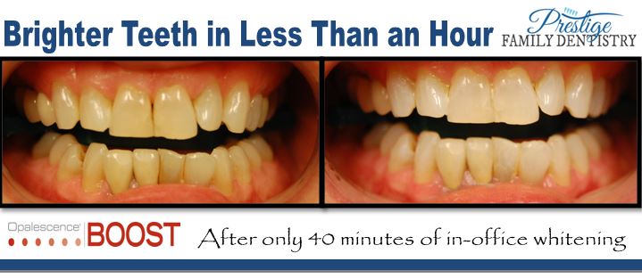 Teeth Whitening | Prestige Family Dentistry