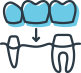 Computer-generated graphic depicting a dental bridge procedure