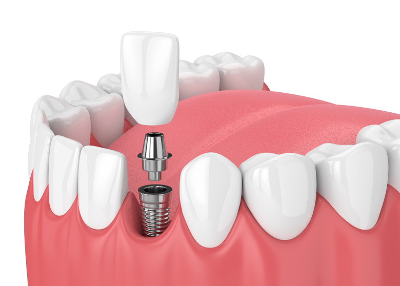 Computer generated graphic showing the dental implant process with a single tooth.