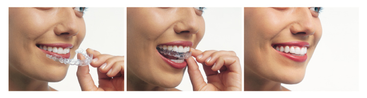 Trio of photos showing a woman inserting an Invisalign tray into her mouth