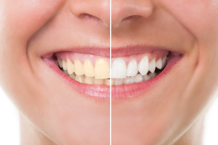 Smiling woman with the left half of the smile a bit yellowed and the right half bright white after professional whitening