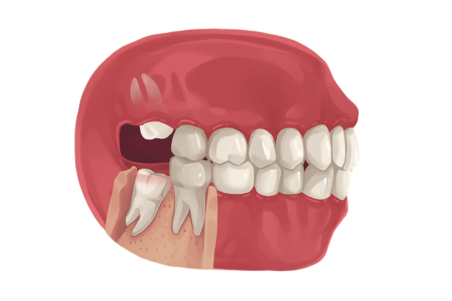 A model showing wisdom teeth emerging at bad angles.