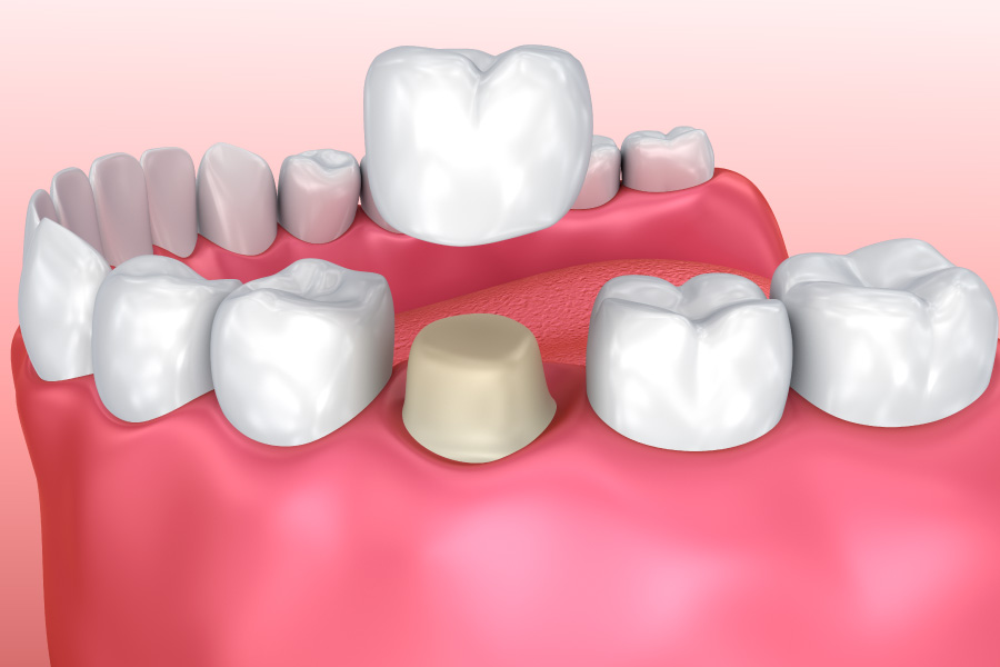 Model showing a dental crown being placed in the bottom palate.