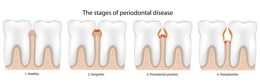 Graphic showing the stages of gum disease.