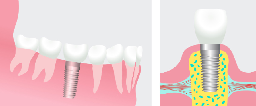 Graphic showing a dental implant.