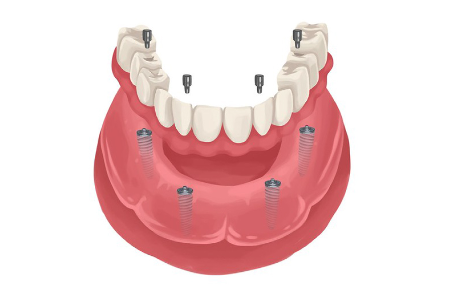 Graphic of implant-supported dentures.