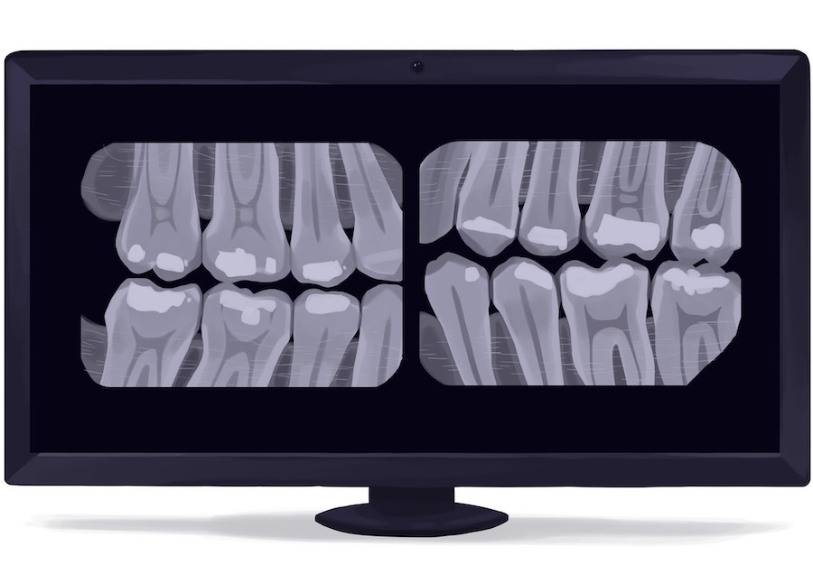 dental X-rays/dental radiographs