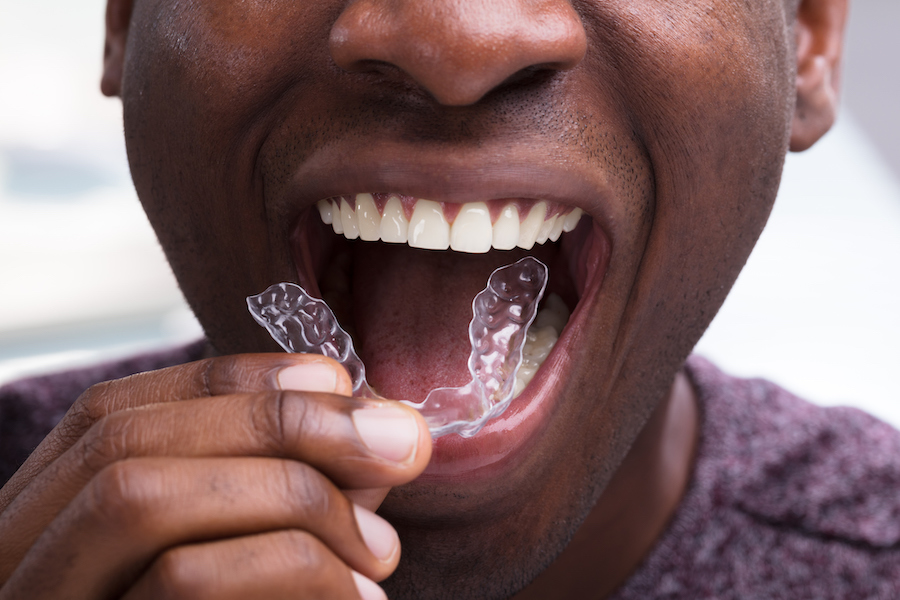 braces for adults, Close-up Of A Man Adjusting Transparent Aligners In His White Teeth